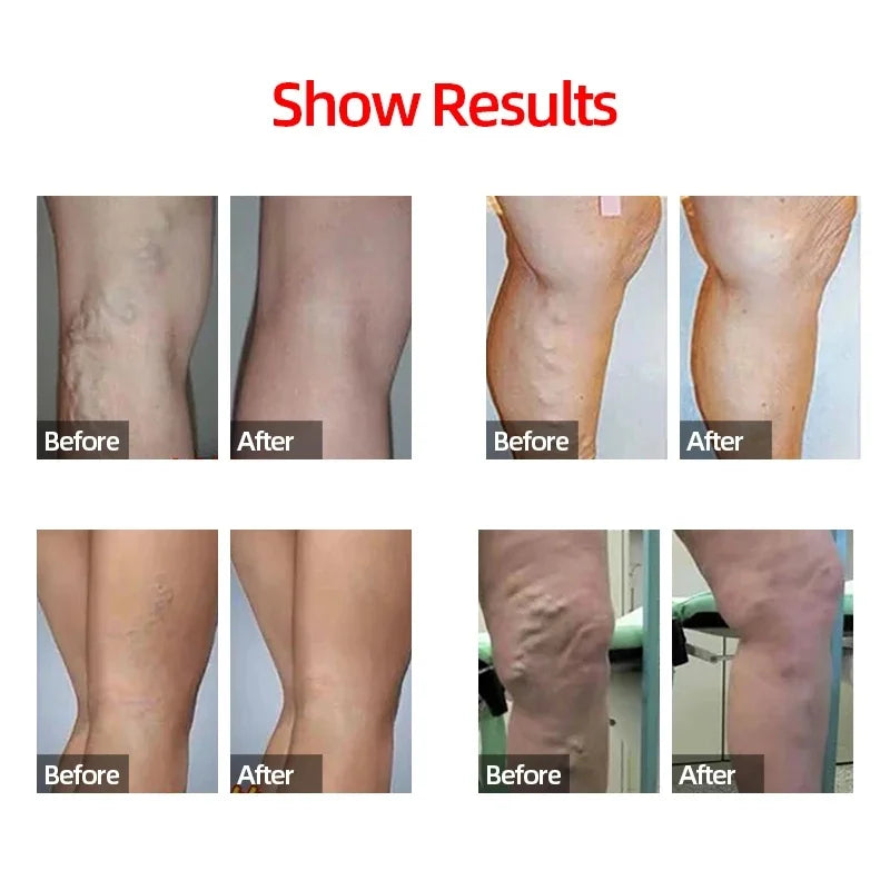 Compression Calf Sleeves – 20–30mmHg Support for Running & Recovery